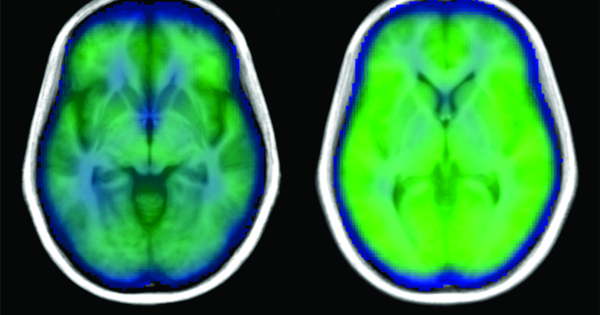 GlucoTrust : GlucoTrust: Intermittent Hypoxia and Insulin Sensitivity — The Connection Between Sleep Apnea and Blood Sugar
