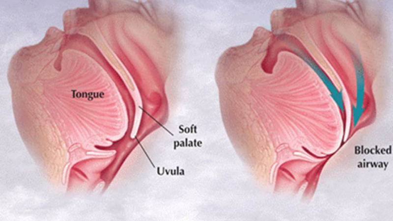 sleep apnea airway blockage illustration