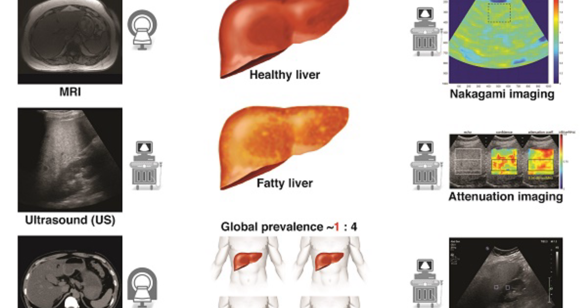 Novuglyca: How Nonalcoholic Fatty Liver Disease Drives Hepatic Gluconeogenesis and High Fasting Glucose