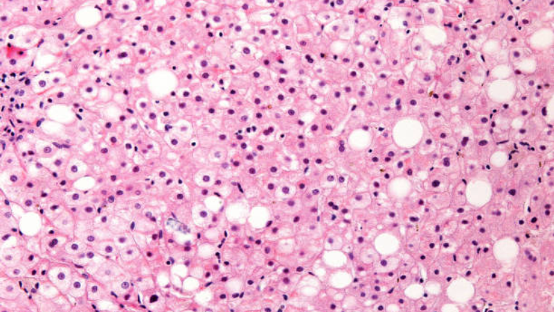 fatty liver histology showing steatosis