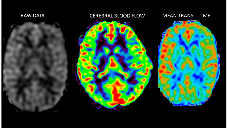 cerebral blood flow comparison between normal and hypoperfused brain
