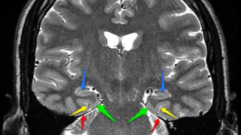 hippocampus brain structure under MRI scan