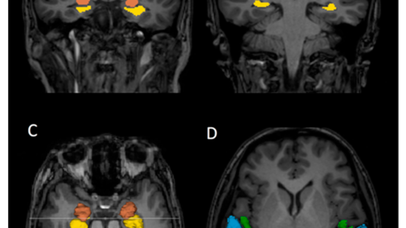 researcher looking at brain scans showing hippocampal changes