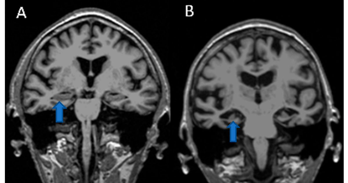 Phytomen One: The Cortisol-Hippocampus Connection – Reversing Stress-Induced Neuroplasticity Decline