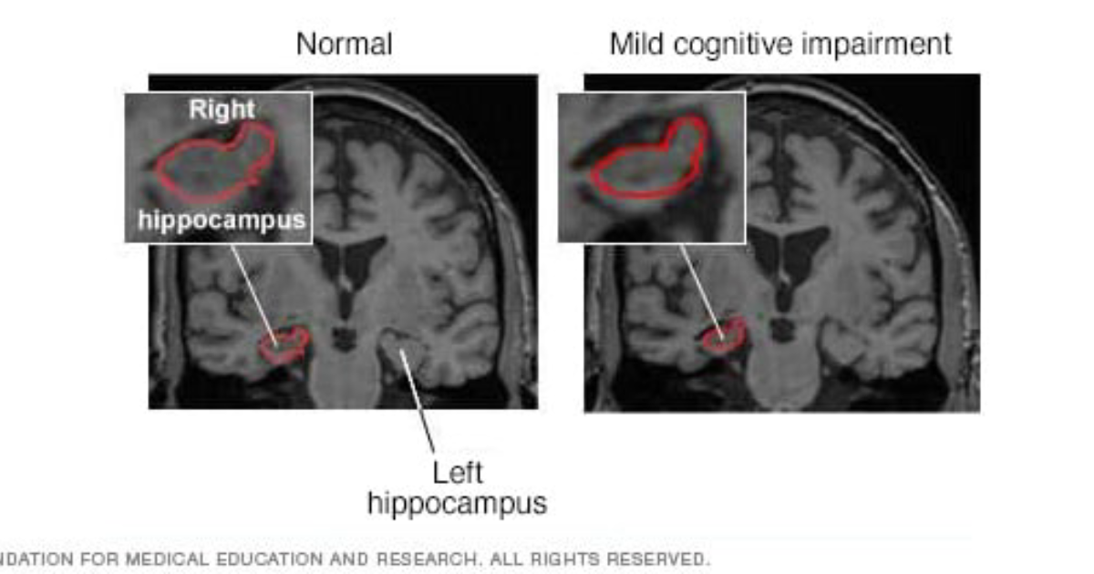 Quantum Brainwave Protocol: Synaptic Pruning Gone Wrong – How Chronic Stress Accelerates Synaptic Plasticity Decline