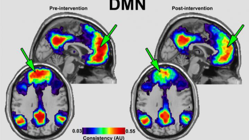 brain scan showing default mode network connectivity