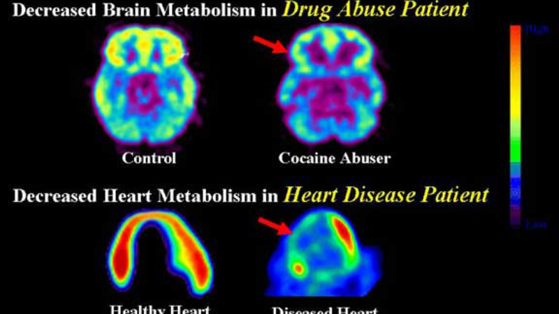 brain reward pathways opioid addiction