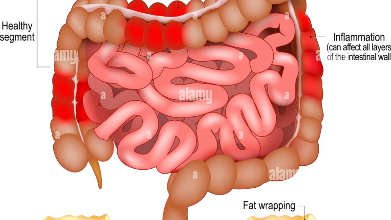 intestinal inflammation anatomy illustration