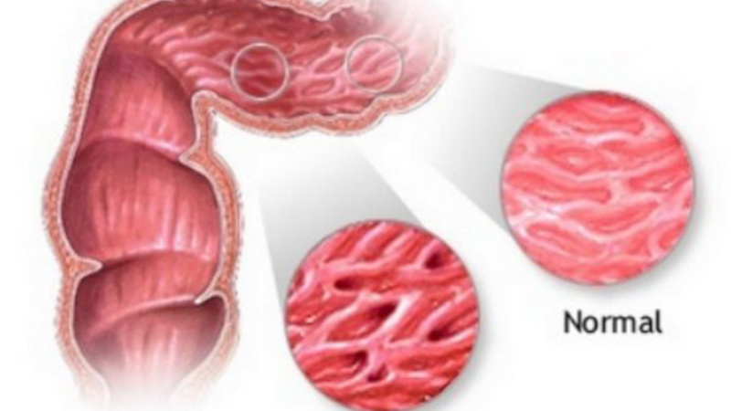 microscope image of healthy vs. inflamed colon tissue with tight junctions