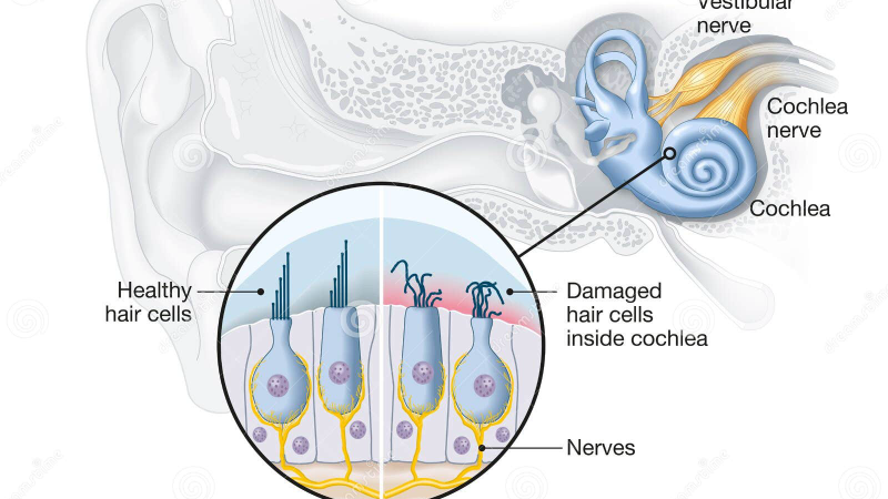 functional MRI brain scan showing auditory cortex activity