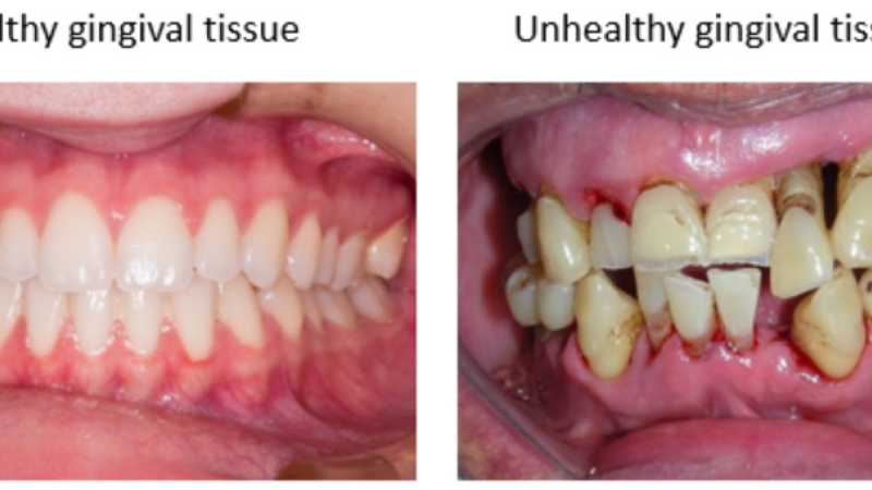 histology slide comparing healthy gingiva (rich vascularity) vs. smoker's gingiva (fibrotic, vascular reduction)