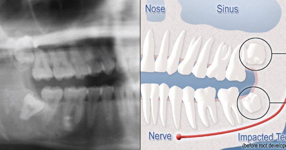 DentaBiome: How Craniofacial Growth Determines Wisdom Tooth Eruption