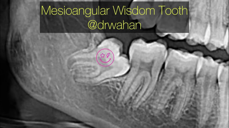 impacted wisdom tooth X-ray showing mesioangular impaction