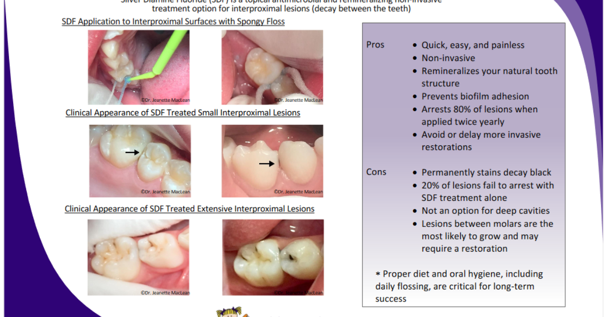 DentaBiome: How Silver Diamine Fluoride Arrests Caries Without Drilling – A Cellular and Clinical Analysis