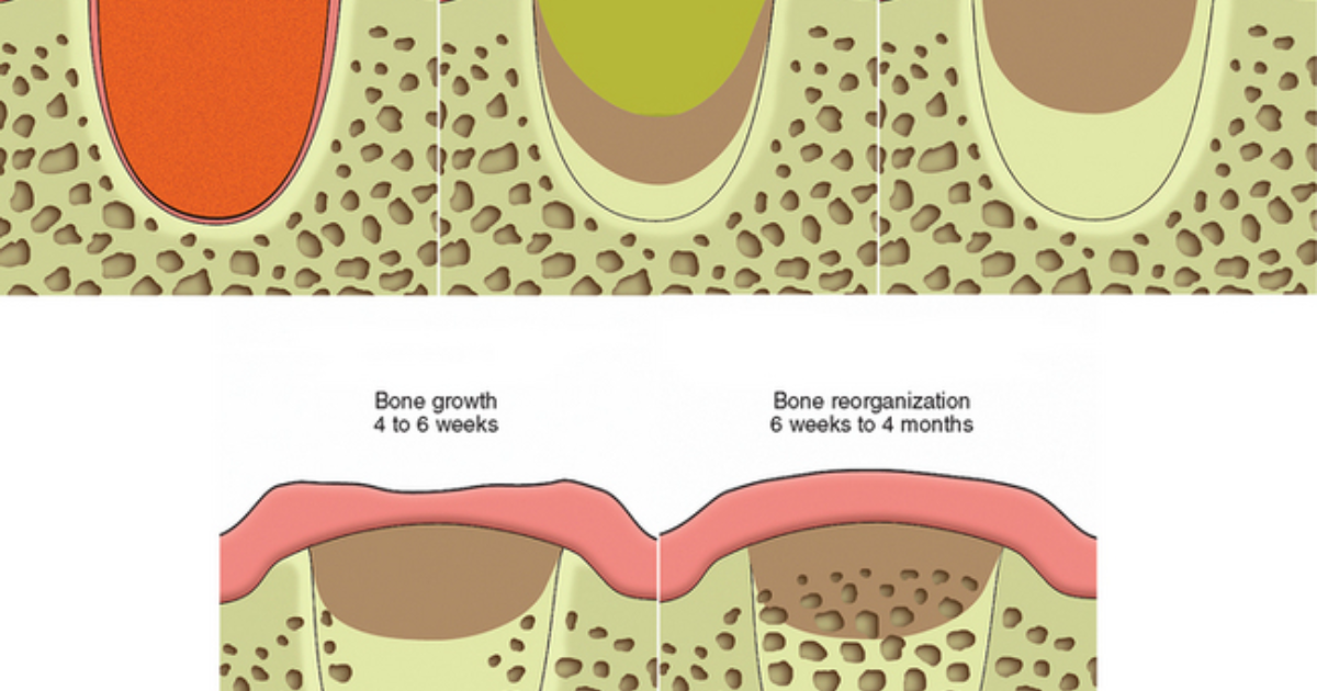 DentaBiome: How Vitamin D Orchestrates Alveolar Bone Remodeling After Tooth Extraction