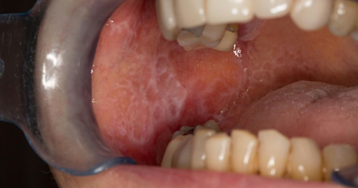 DentaBiome: Oral Lichen Planus – Immune-Mediated Pathways and Clinical Management