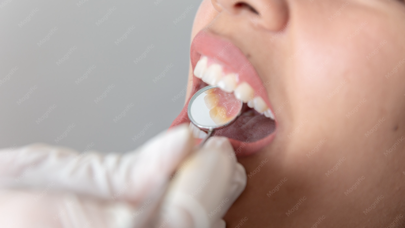 oral lichen planus white lacy patches on buccal mucosa close-up