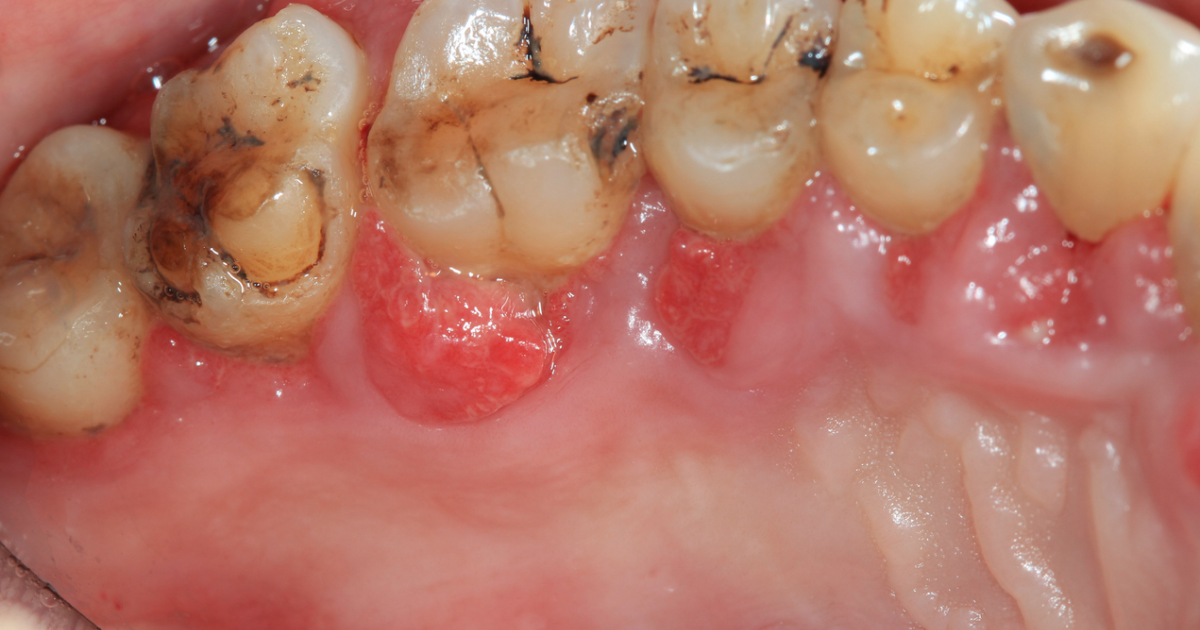DentaBiome: The Hidden Threat of E-Cigarettes to Your Gingival Health