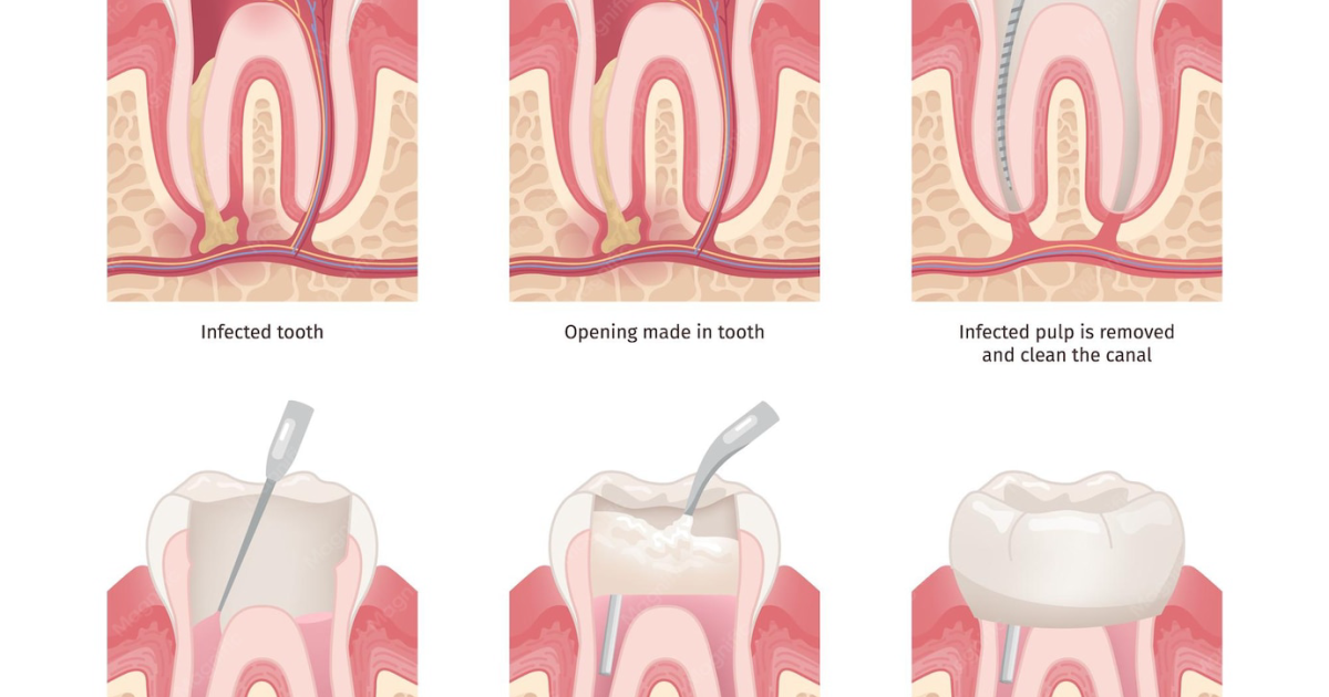 DentaBiome: The Natural Pathway to Post-Root Canal Healing and Oral Microbiome Balance