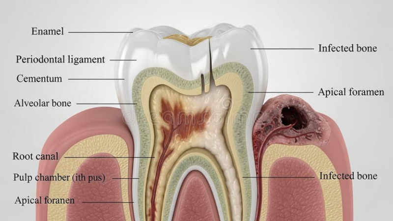 tooth cross-section showing infected pulp and abscess formation