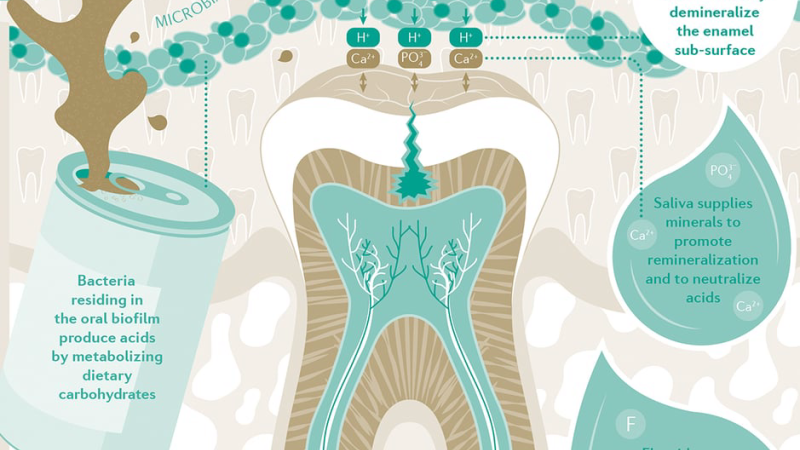 cross-section of tooth enamel showing demineralization and remineralization with fluoride ions
