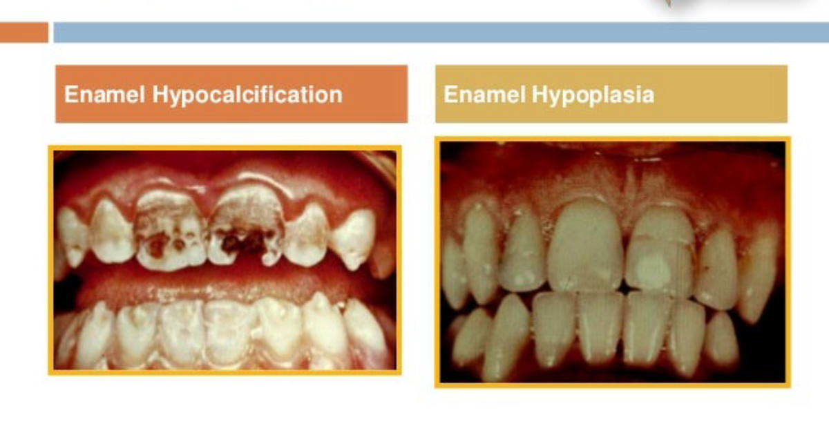Oradentum: How Genetic Predisposition to Enamel Hypoplasia Increases Caries Susceptibility and What You Can Do About It