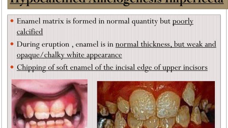 microscopic image of enamel hypoplasia showing thin pitted enamel surface