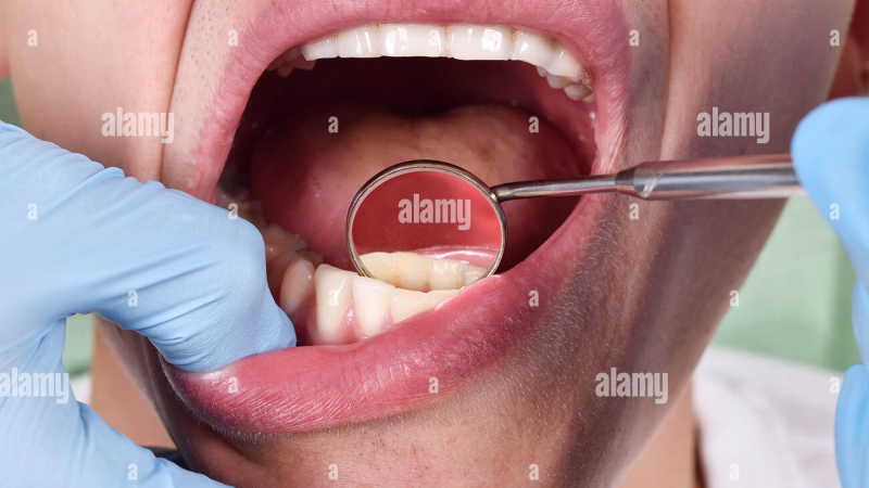 dentist examining a patient's teeth with a mirror, close-up