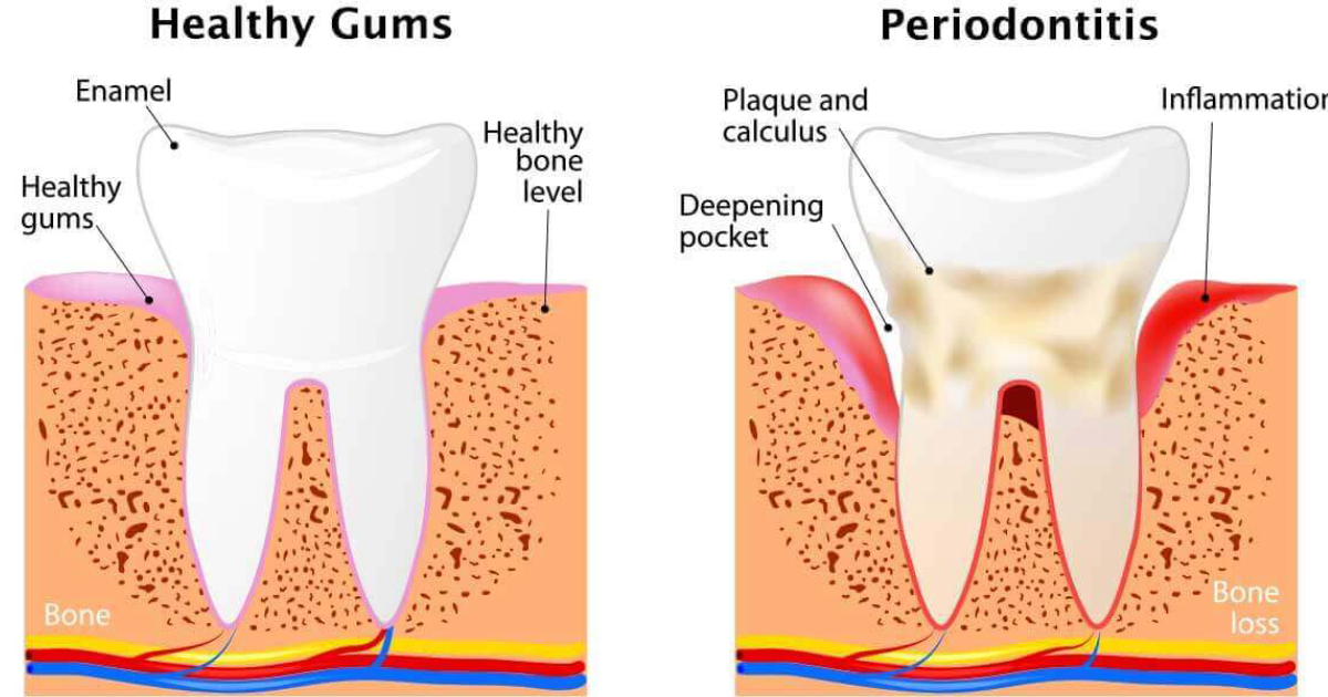 Oradentum: How Gum Disease Triggers Systemic Inflammation – The Oral-Heart Axis Explained