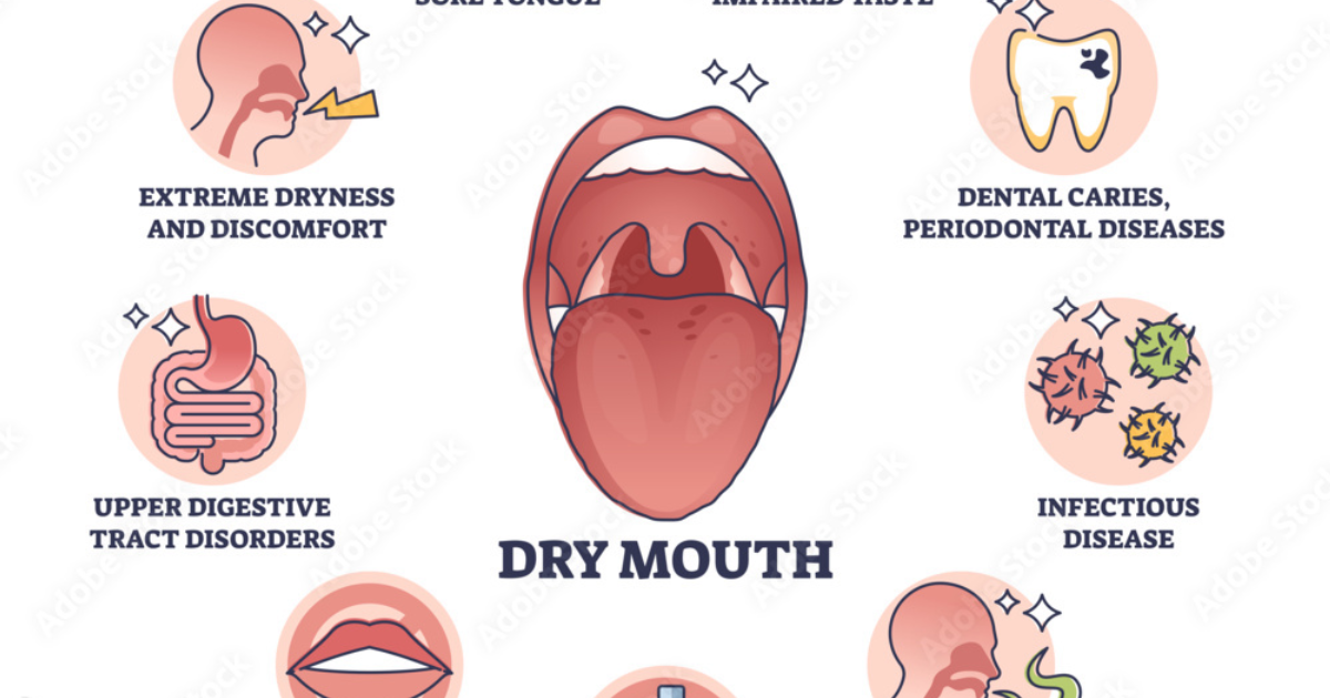 Oradentum: How Long-COVID Salivary Gland Dysfunction Triggers Xerostomia-Induced Caries