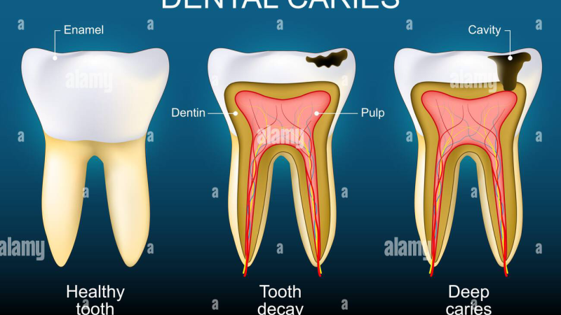 cross-section illustration of tooth showing demineralization and caries progression