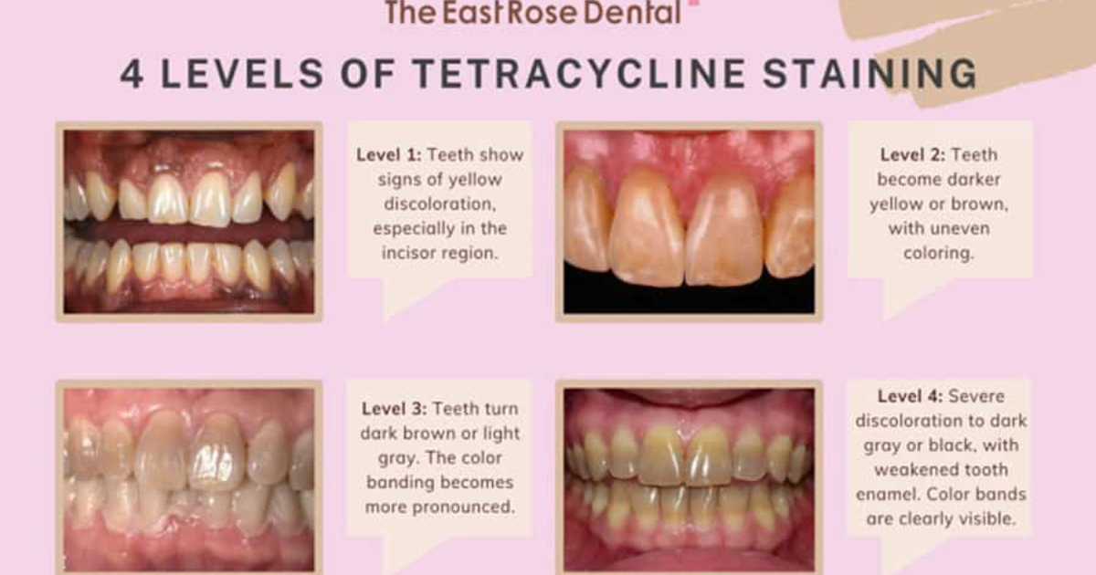 Oradentum: The Cellular Mechanism of Tetracycline Staining and How Systemic Support Can Restore Your Smile