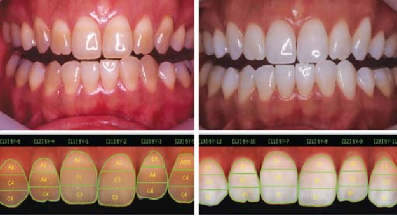 tetracycline stained teeth showing banding patterns