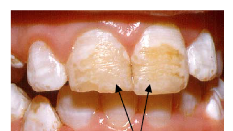 illustration of tooth enamel structure showing enamel rods and hypoplastic defects