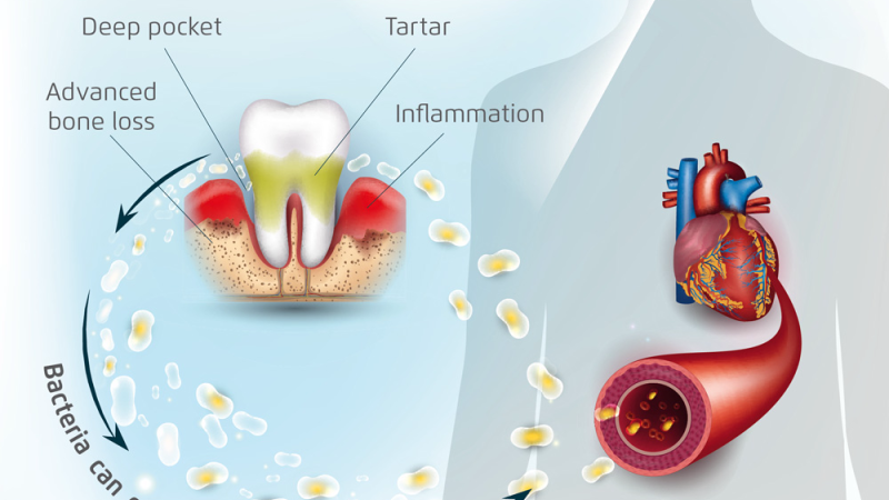 illustration of oral bacteria crossing into the bloodstream
