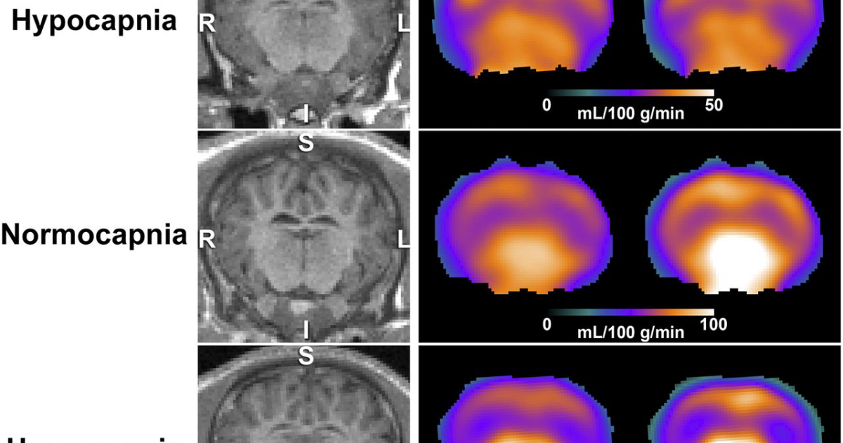 Harmobrain: El papel de la hipoperfusión cerebral en el deterioro cognitivo