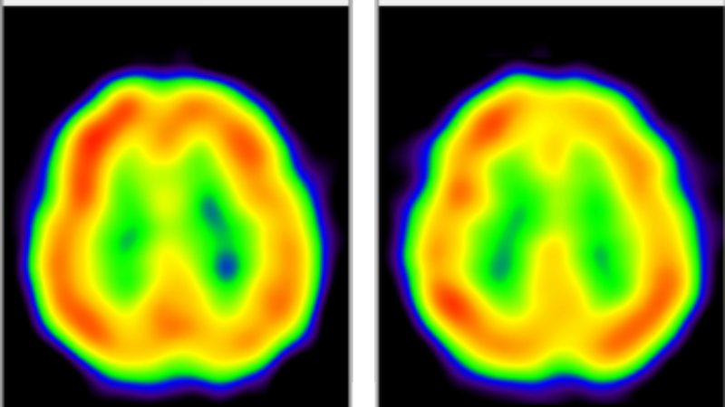 brain hippocampus highlighted