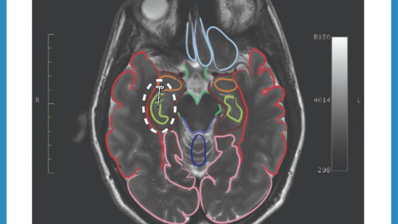 synaptic connection healthy neuron with omega-3 fatty acids
