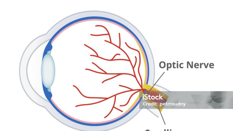 optic nerve inflammation cytokines cascade