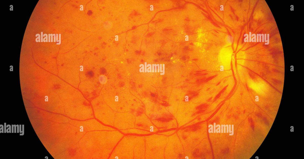 Visivra: Cómo la retinopatía diabética destruye la visión desde adentro