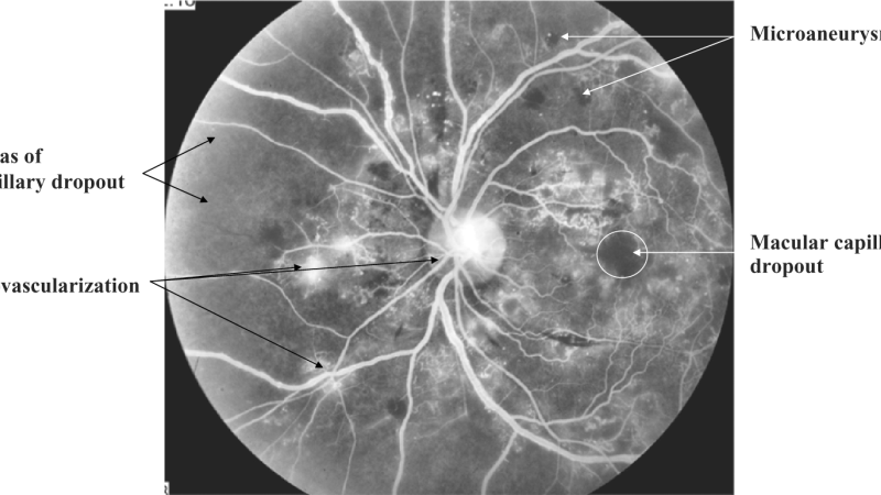 diabetic retina capillary damage microscopic view