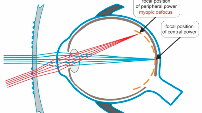 corneal topography map showing flattening