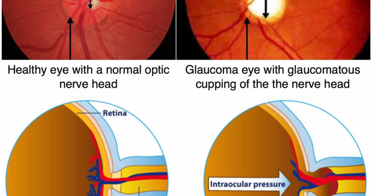 Visivra: Entendiendo el vínculo entre la presión intraocular y el glaucoma para proteger su visión