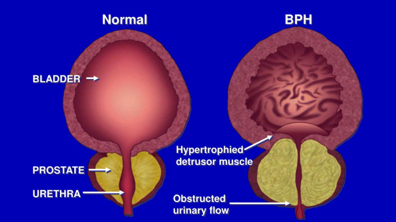 close-up medical illustration showing an enlarged prostate compressing the urethra