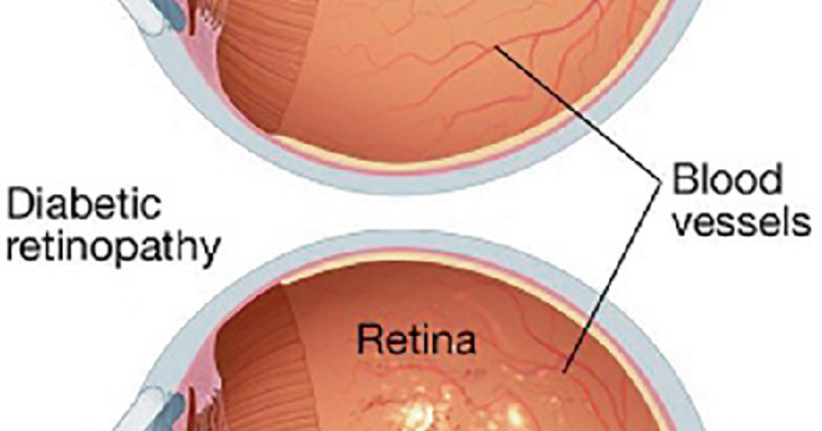 Visivra: Diabetic Retinopathy and the Path to Restoring Retinal Integrity
