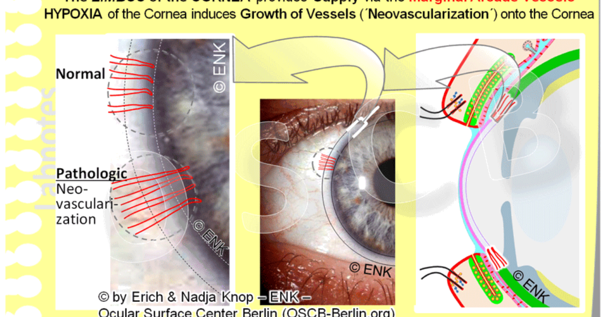 Visivra: How Corneal Hypoxia from Contact Lenses Elevates Microbial Keratitis Risk – and a Natural Solution for Ocular Health