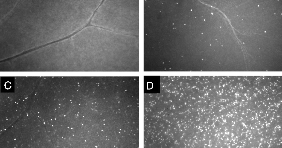 Visivra: How Excitotoxicity and Apoptosis Drive Glaucoma Vision Loss — and the Natural Compounds That Intervene