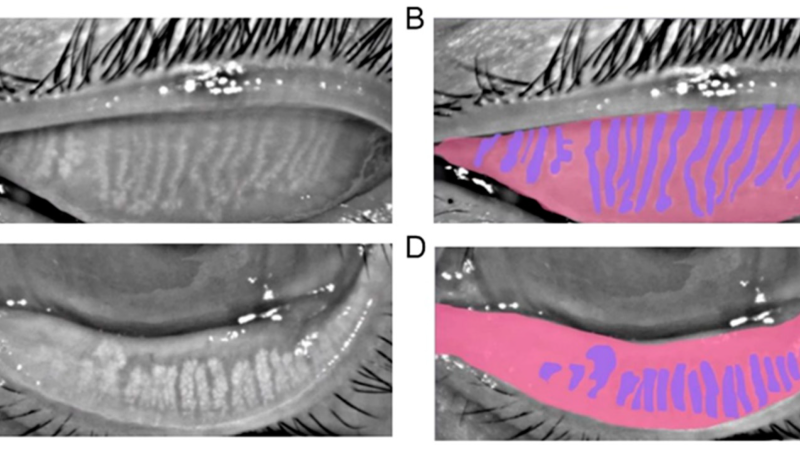 meibomian gland imaging infrared meibography