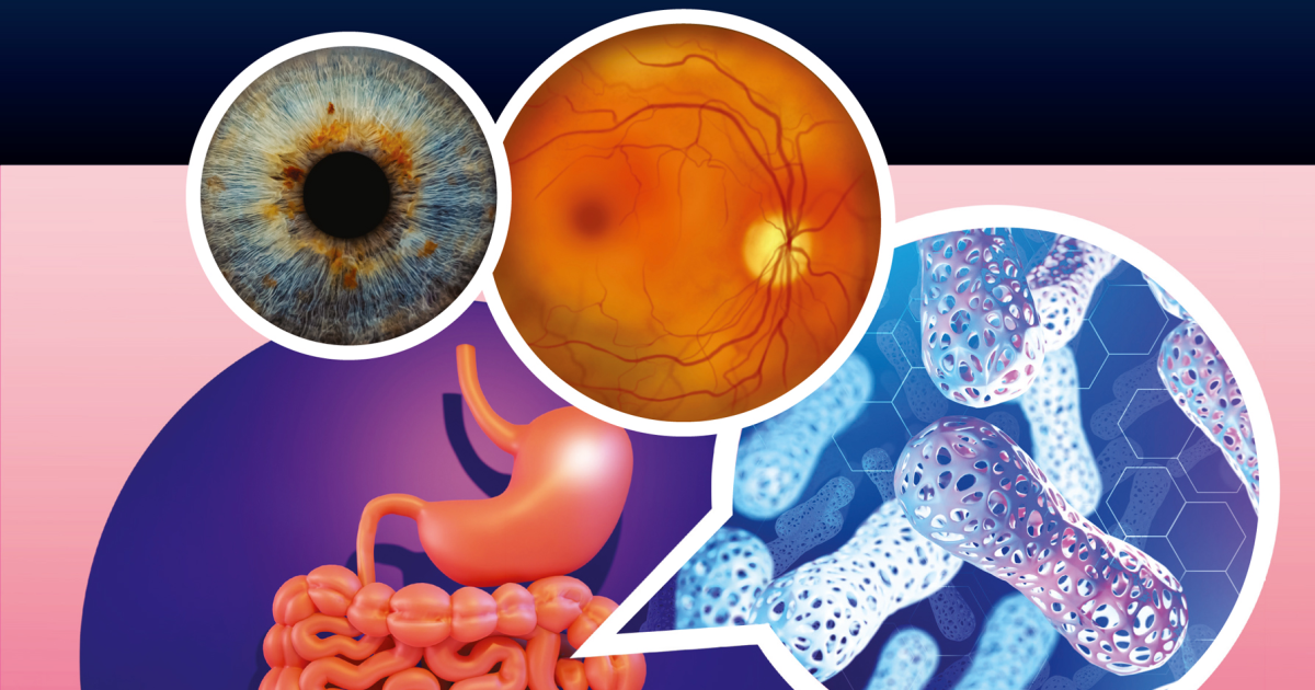 Visivra: The Gut-Eye Axis and the Hidden Trigger of Uveitis