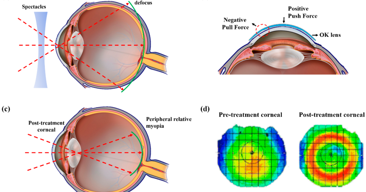 Visivra: The Mechanistic Effect of Corneal Remodeling on Peripheral Refraction in Myopia Control